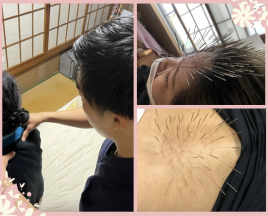 メニュー：ルート治療（ショートコース） イメージ